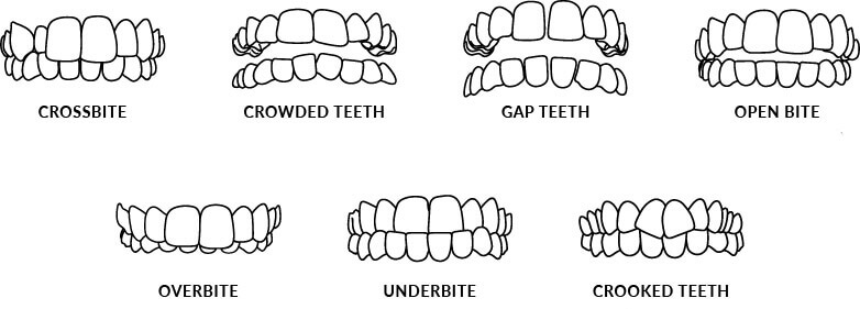 Cas traitables Invisalign